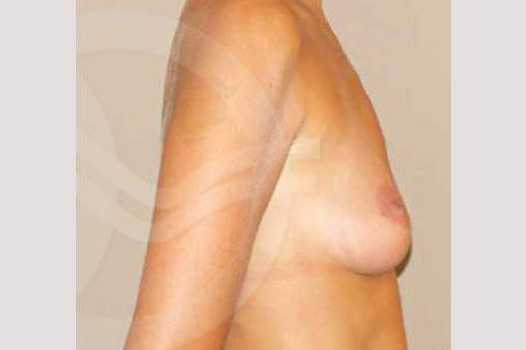 Breast Augmentation 325cc High Profile ante/post-op III