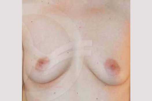 Breast Augmentation 400cc Silicone Implants ante/post-op I