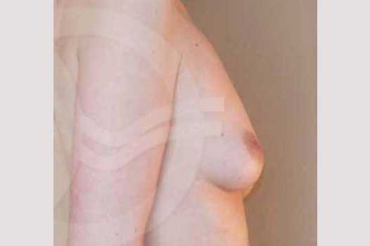Photos Breast Augmentation  ante/post-op III