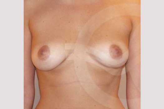 Photos Breast Augmentation  ante/post-op I