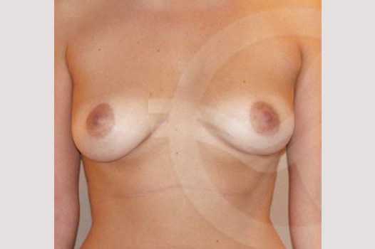 Breast Augmentation 380cc High Profile ante/post-op I