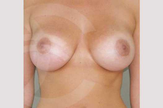 Breast Augmentation 380cc High Profile ante/post-op I