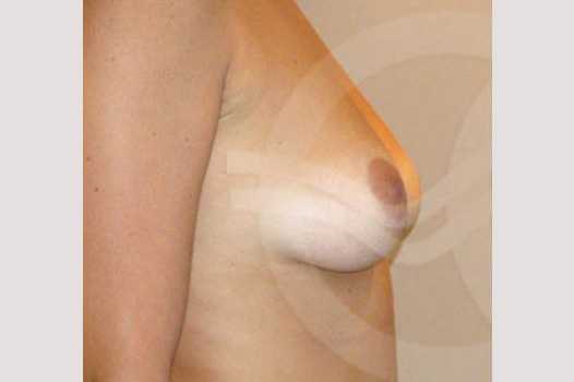 Breast Augmentation 380cc High Profile ante/post-op III