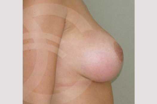 Breast Augmentation 380cc High Profile ante/post-op III