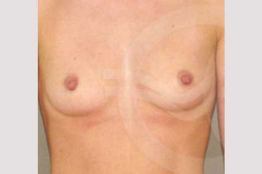 Breast Augmentation 350cc High Profile ante/post-op I