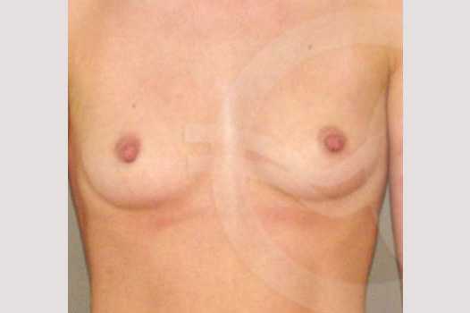 Photos Breast Augmentation  ante/post-op I