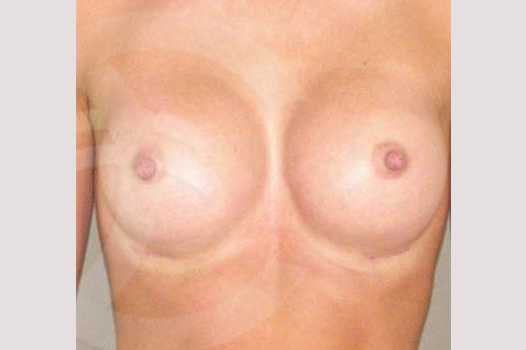 Breast Augmentation 350cc High Profile ante/post-op I