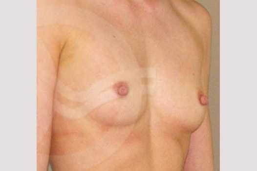 Photos Breast Augmentation  ante/post-op II
