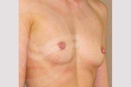 Breast Augmentation 350cc High Profile ante/post-op II