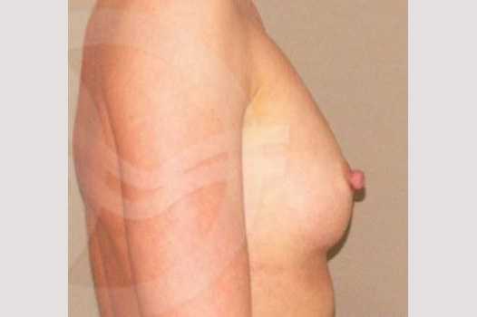 Photos Breast Augmentation  ante/post-op III