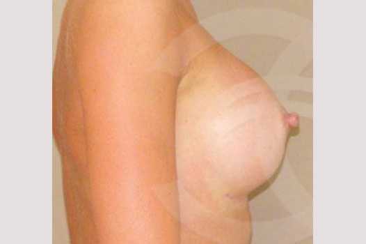 Photos Breast Augmentation  ante/post-op III
