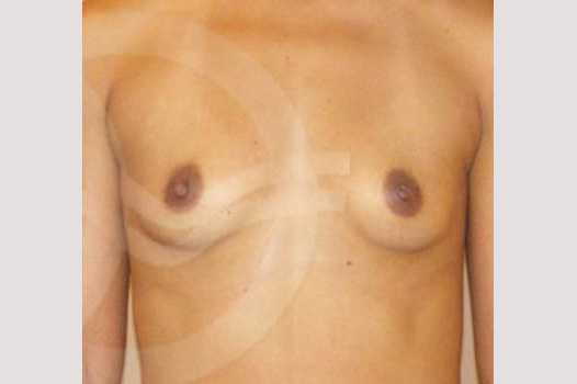 Breast Augmentation 325cc Submuscular ante/post-op I