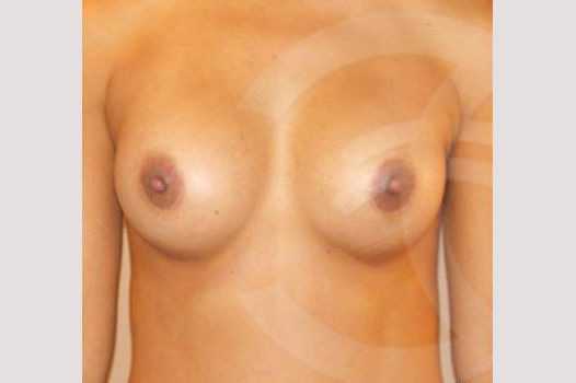 Breast Augmentation 325cc Submuscular ante/post-op I