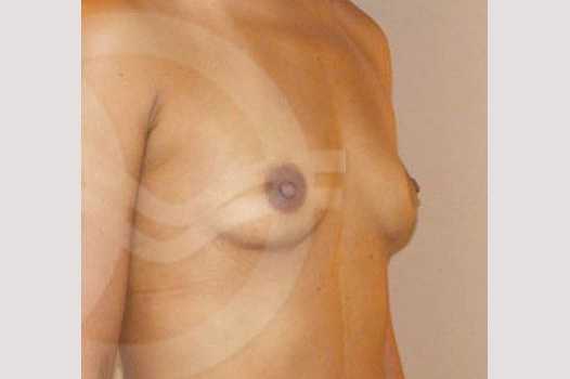 Breast Augmentation 325cc Submuscular ante/post-op II