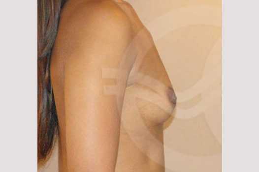 Breast Augmentation 325cc Submuscular ante/post-op III