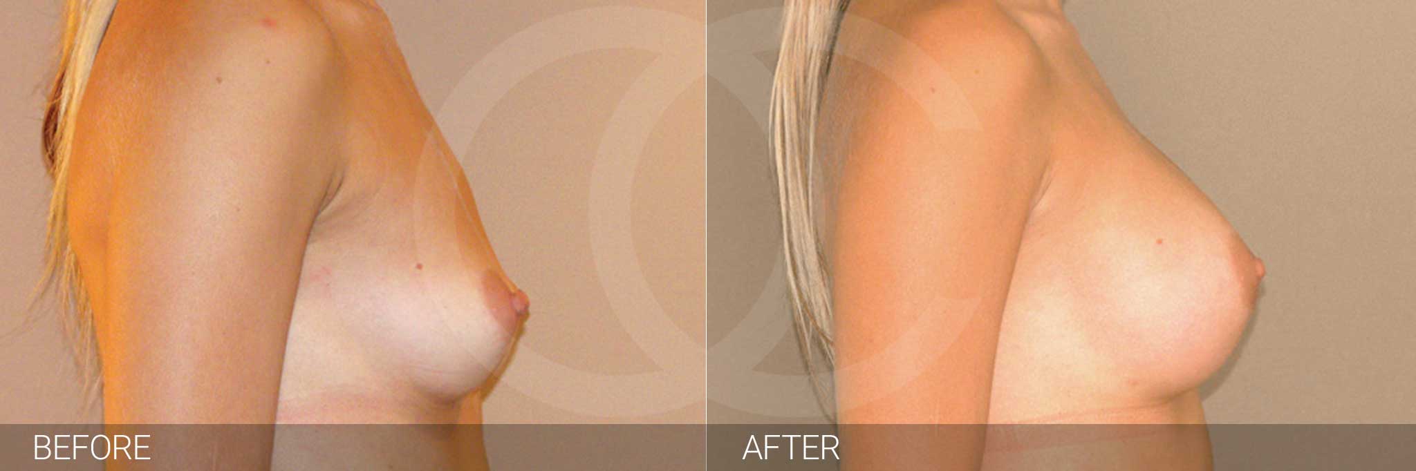 Antes y después - Implantes mamarios de aspecto natural | Ocean Clinic Marbella