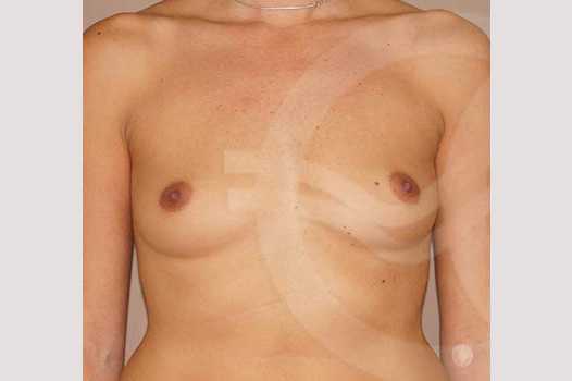 Breast Augmentation 380cc Submuscular ante/post-op I