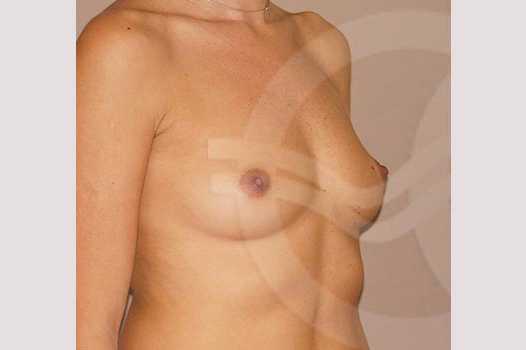 Breast Augmentation 380cc Submuscular ante/post-op II