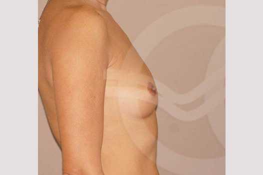 Breast Augmentation 380cc Submuscular ante/post-op III
