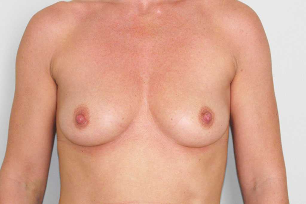 Breast Augmentation Submuscular implant ante/post-op I