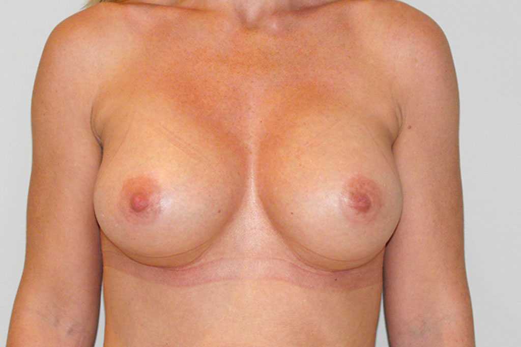 Breast Augmentation Submuscular implant ante/post-op I