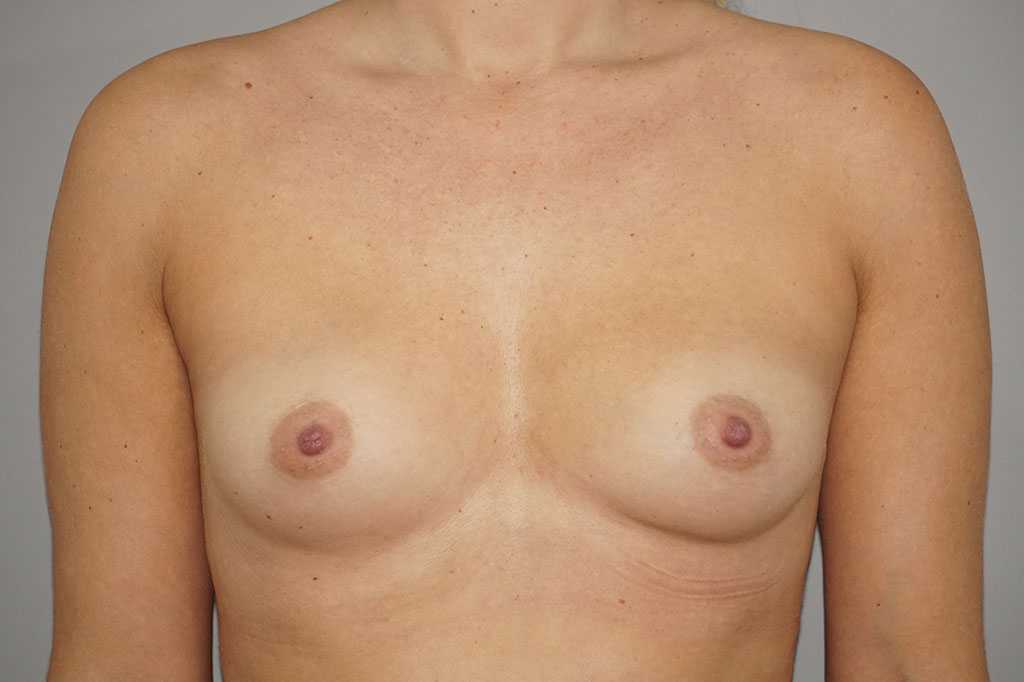 Augmentation mammaire 280cc anatomique prothèses silicone  ante-op profil