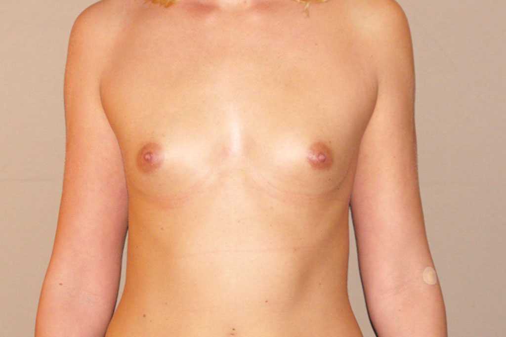 Augmentation mammaire Prothèse en silicone ante-op profil