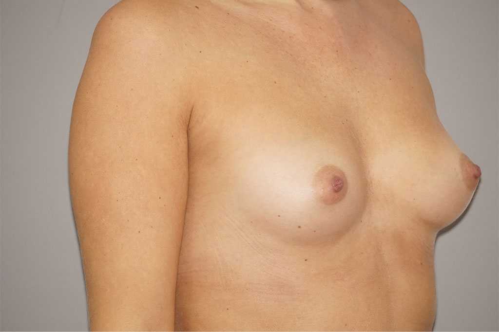 Augmentation mammaire Prothèses mammaires 280cc profil haut ante-op lateral