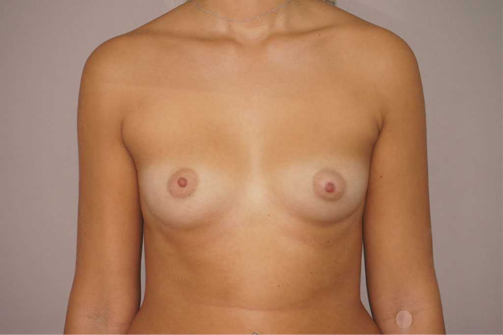 Breast Augmentation Nagor Anatomical 485cc ante/post-op I