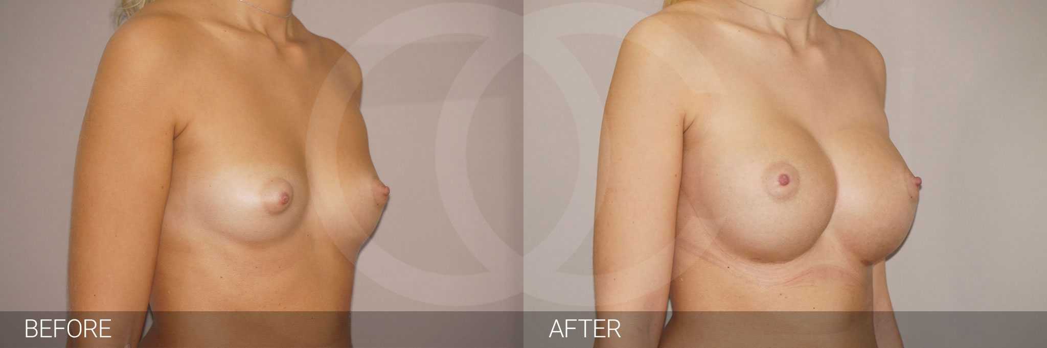 Breast Augmentation Nagor Anatomical 485cc ante/post-op II