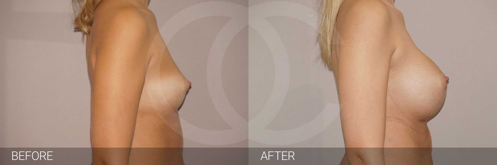Breast Augmentation Nagor Anatomical 485cc ante/post-op III