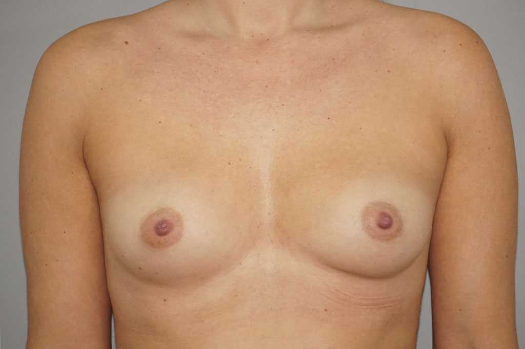 Brustvergrößerung 280cc Anatomisch Hochprofil ante/post-op I