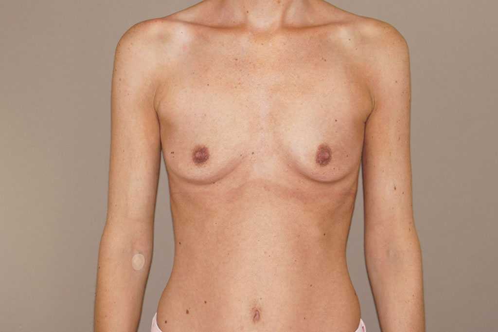 Brustvergrößerung 375cc Anatomisch Hochprofil ante/post-op I