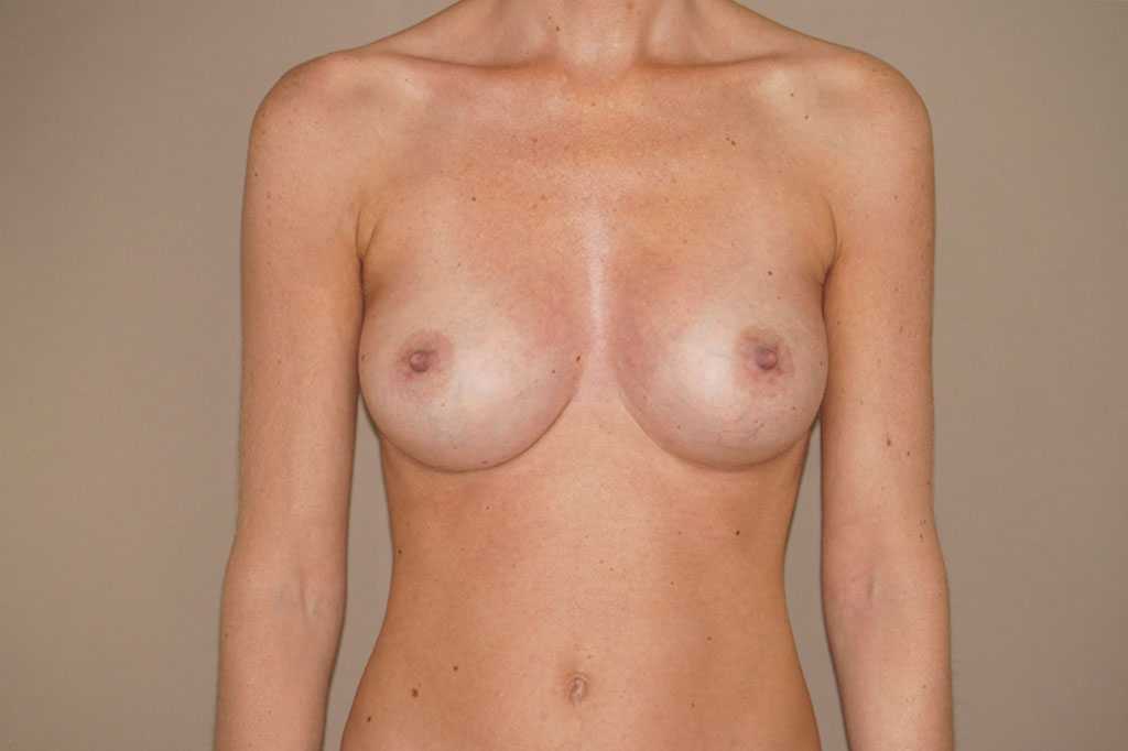 Brustvergrößerung 16 BRUSTIMPLANTATE SILIKON 375CC ANATOMISCH HIGH PROFILE post-op profil