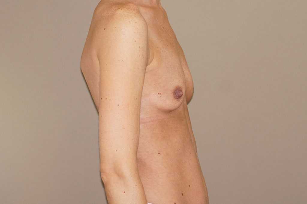 Brustvergrößerung 375cc Anatomisch Hochprofil ante-op lateral