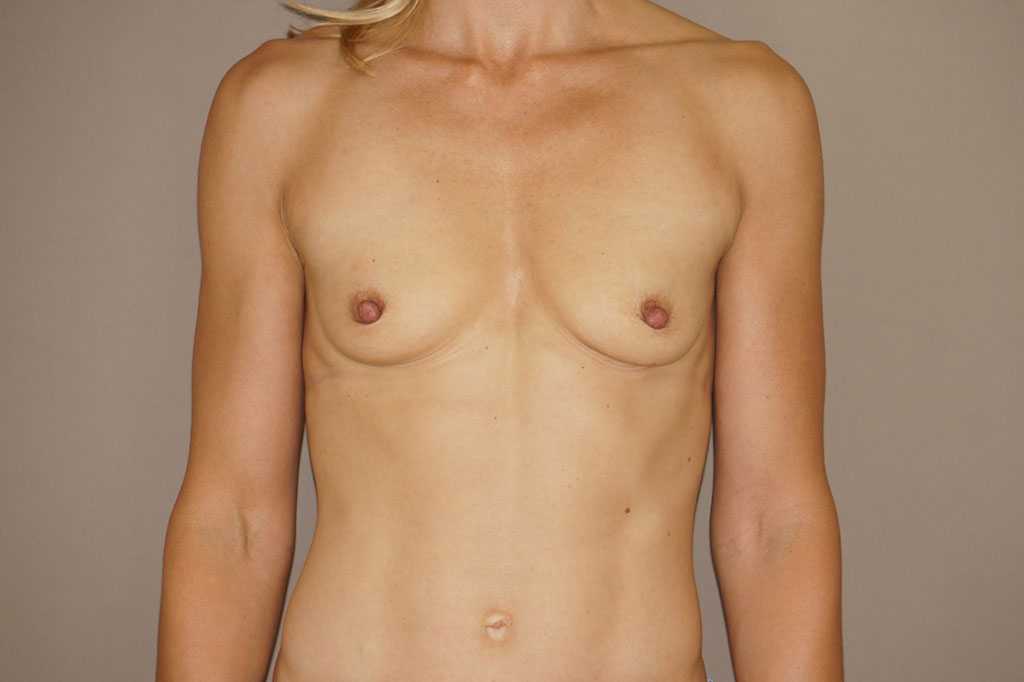 Augmentation mammaire Prothèses mammaires en silicone ante-op profil