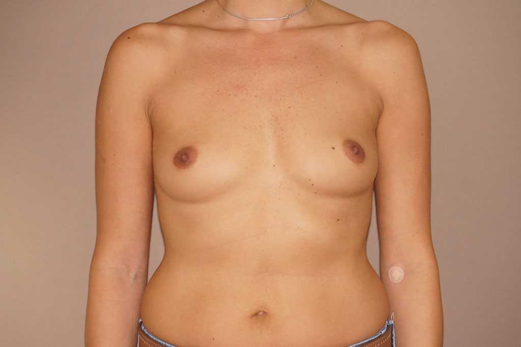 Breast Augmentation Silicone Implants ante/post-op I