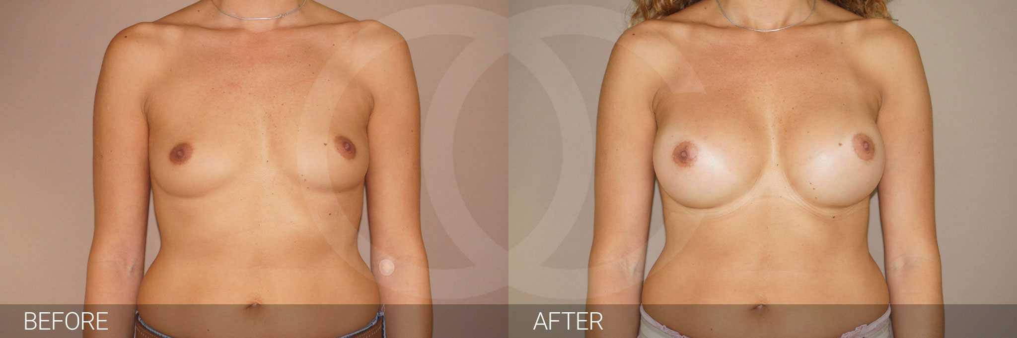 Antes y después aumento pecho implantes silicona caso clínico 8 Marbella Ocean Clinic - frontal