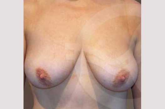 Breast Lift Breast Uplift ante/post-op I