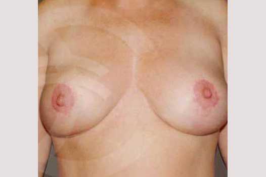 Bruststraffung 350ccm Brustimplantate ante/post-op I
