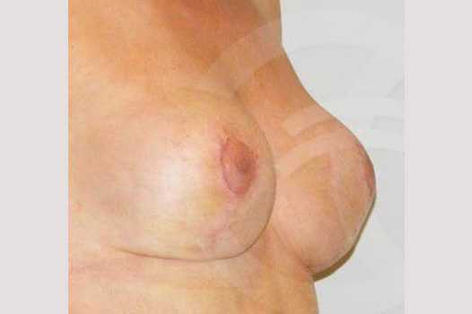 Breast Lift Breast Uplift ante/post-op II