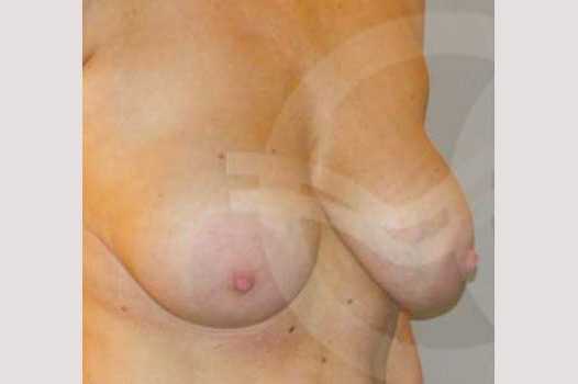 Breast Lift Benelli Technique ante/post-op I