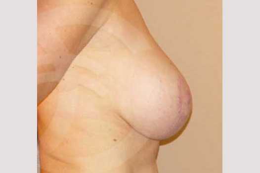 Breast Lift Benelli Technique ante/post-op II