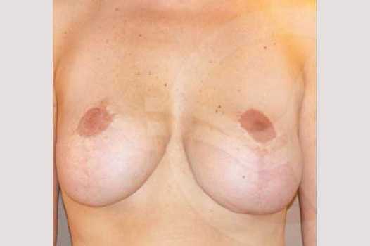 Breast Lift Correction of Bottoming Out ante/post-op I