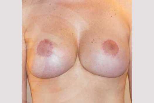 Breast Lift Correction of Bottoming Out ante/post-op I