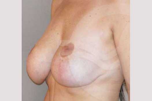Breast Lift Correction of Bottoming Out ante/post-op II