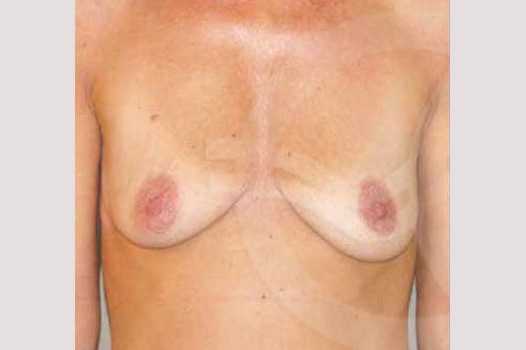 Breast Lift Uplift with 325cc Implants ante/post-op I