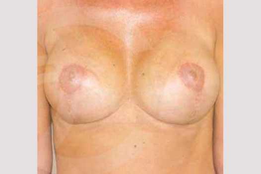 Breast Lift Uplift with 325cc Implants ante/post-op I