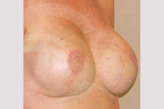 Breast Lift Uplift with 325cc Implants ante/post-op II