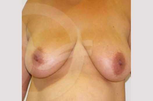 Breast Lift Vertical Incision ante/post-op I